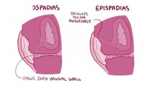 Hypospadias amp epispadias causes symptoms diagnosis treatment pathology [upl. by Eyoj146]