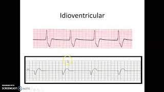 Idioventricular Rhythm [upl. by Queenie692]