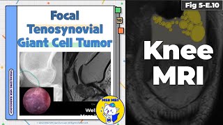 Fig 5E10 Localizedtype Tenosynovial Giant Cell Tumor [upl. by Areta]