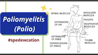 Poliomyelitis  Polio  Causes Symptoms Diagnosis Treatment Pathology Educational Implications [upl. by Dwinnell]