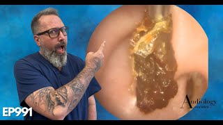 HOW TO SAFELY REMOVE A HUGE EAR WAX PLUG Earwax removal  EP991 [upl. by Abihsat306]