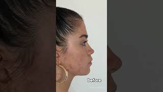 Chin Filler Injection by Bahareh [upl. by Eimmac]