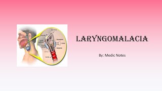 Laryngomalacia  etiology signs amp symptoms investigation treatment [upl. by Dabney453]