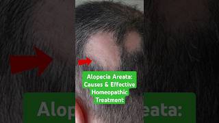 Alopecia Areata Causes amp Effective Homeopathic Treatment shorts [upl. by Ecniv]