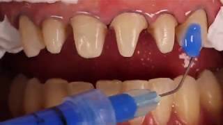 Adhesive cementation of ceramic veneers [upl. by Mufi]