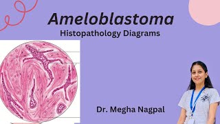 Ameloblastoma  Histopathology  Easiest Diagrams  Oral Pathology BDS [upl. by Collum646]