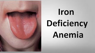 Iron Deficiency Anemia [upl. by Eirdua142]