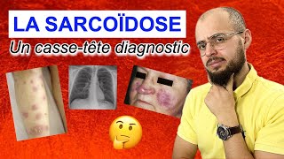 La SARCOÏDOSE  Une maladie digne dun épisode de Dr HOUSE [upl. by Troxell]