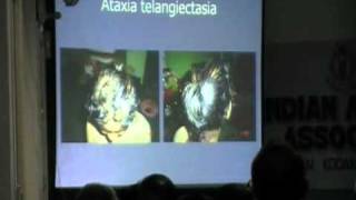 Ataxia telangiectasia  DrJBhaskar  Part 1 of 2 [upl. by Htessil789]