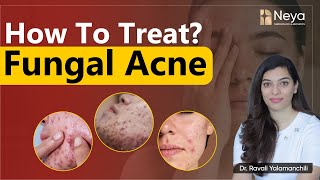 Causes of fungal acne on Face  How to treat fungal acne  Acne treatment in hyderabad [upl. by Lerret76]