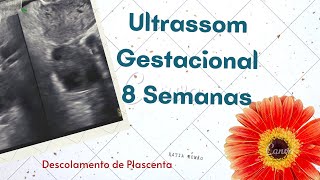 Ultrassom Gestacional 8 semanas  descolamento de placenta [upl. by Amluz]