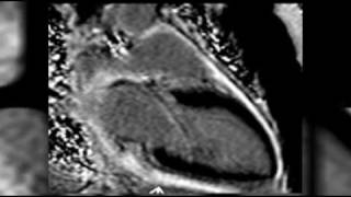 Cardiac MRI Cases on radRoundscom Radiology Network [upl. by Frederich]