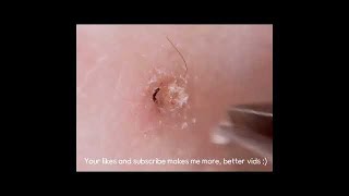 Tweezist Plucking ingrown hair compilation 2 [upl. by Rola]