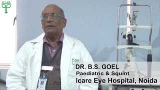 Squint Bhengapan explained by Dr BS Goel at Icare eye hospital Noida NCR India [upl. by Yenahs]