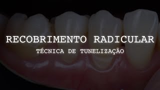 Recobrimento radicular sem retalho com técnica de tunelização [upl. by Bremble808]