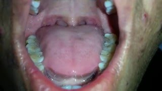 Tongue Fasciculation in MND [upl. by Portingale]