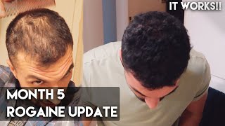 5 Month Rogaine Update Minoxidil  IT WORKS [upl. by Jayme]