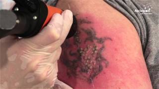 TattooStar  Training video for tattoo removal from Asclepion [upl. by Fernald41]