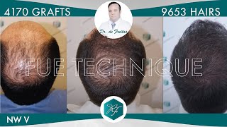 Injerto Capilar Técnica FUE – 4170 Grafts 9653 Pelos – Dr Rafael de Freitas [upl. by Auria]