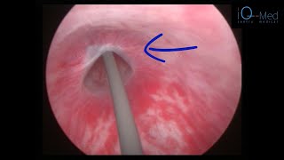 Strictura de uretra bulbara  aspect endoscopic [upl. by Melliw]