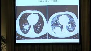 Why is invasive aspergillosis such a difficult disease to diagnose and treat [upl. by Rastus]