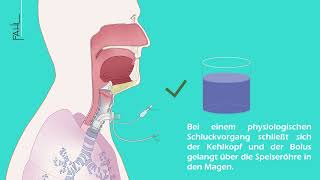 Subglottische Absaugung einer Trachealkanüle  Animation  Andreas Fahl MedizintechnikVertrieb GmbH [upl. by Eerpud]