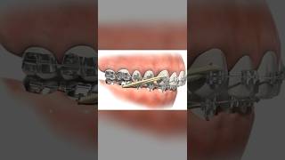 Class II elastics in Orthodontics braces teeth dental allaboutbraces [upl. by Nonaihr]