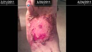 2nd Degree burns on foot  healing time lapse  2 months [upl. by Missak]