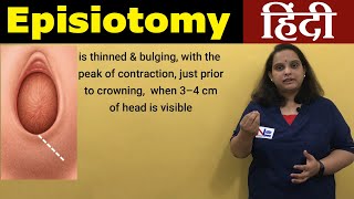 Episiotomy in Hindi  Perineotomy  Nursing Lecture [upl. by Madge]