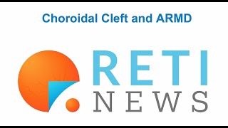 Choroidal Cleft and nARMD activity [upl. by Hniv]