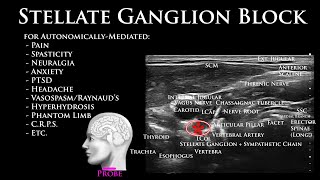 Stellate Ganglion Block  How and Why  UltrasoundGuided Technique and Outcome [upl. by Ferriter]