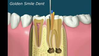 Kanal Tedavisi Nasıl Yapılır  GoldenSmileDent [upl. by Hagep]