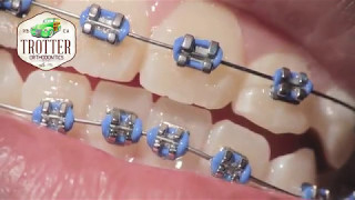 Watch How Braces Are Put On  Orthodontic Treatment Using Fixed Brackets Redondo Beach Orthodontist [upl. by Rollo]