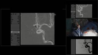 Endovascular coil embolization of 2 cerebral aneurysms [upl. by Maroney]