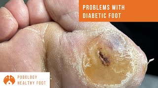 Problems with diabetic foot  wound treatment removal of hyperkeratosis [upl. by Ecertal]