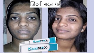 Kozimax Skin Lightening Cream  Uses Side effectsReviews Composition In Hindi [upl. by Ylek]