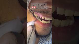 عملية تنضيف الاسنان ضروري جدا جدا  اغرب حالة😳😳🚨 dentalcare scaling تنضيفالاسنان [upl. by Onibas759]