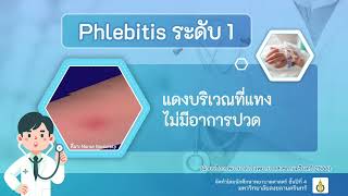 ภาวะหลอดเลือดดำอักเสบ Phlebitis หอผู้ป่วยพิเศษเฉลิมพระบารมี 9 โรงพยาบาลสงขลานครินทร์ [upl. by Gillan355]