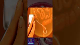 Peritoneal Dialysis  Short Medical Animation [upl. by Anirbed576]