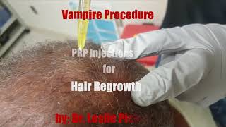 Hair Loss Try PRP Injections by Dr Pickens [upl. by Denna927]