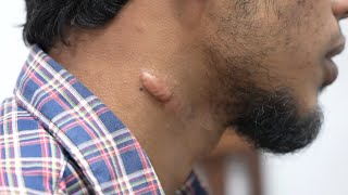 Keloid Scar on Neck Removal Consultation  Dr Sunil Richardson [upl. by Lanni]