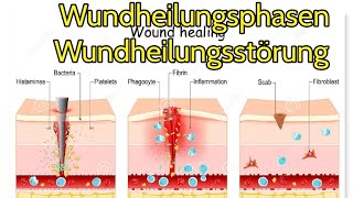 Wundheilungsphasen und wundheilungsstörung im Überblick [upl. by Haletta206]