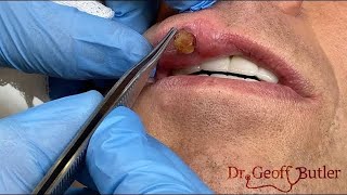 Removal of a pyogenic granuloma on the lip [upl. by Donaugh]