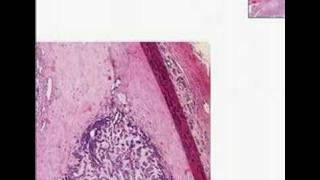 Histopathology Salivary glandAdenoid cystic carcinoma [upl. by Westphal]