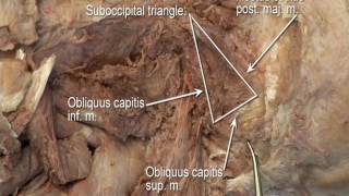 11 Step 5 Suboccipital triangle [upl. by Mirisola]