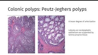 GI polyps GIPATH [upl. by Rodnas]