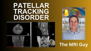 Patellar tracking disorder [upl. by Annoyk]