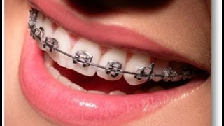 Esto es lo que debes de saber ANTES de ponerte brackets frenos dentales u Ortodoncia [upl. by Isus]