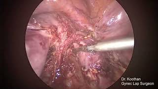 Complete Bicorporeal uterus with septate cervix with Rectovesical fusion [upl. by Ecnerolf]