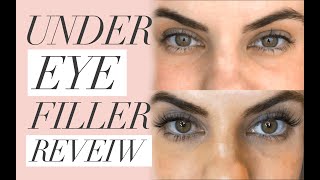 UNDER EYE FILLERS FOR UNDER EYE HOLLOWS AND DARKNESS  Before amp After [upl. by Dustman481]